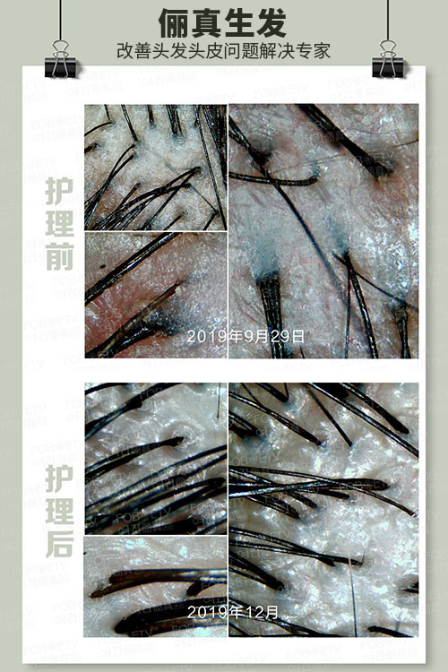 頭油、頭癢